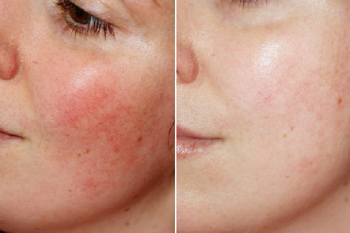 "Giải cứu" làn da sau những ngày trang điểm nhiều