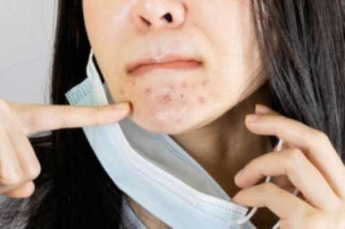 Bật mí 5 cách để xử lý mụn do khẩu trang gây ra