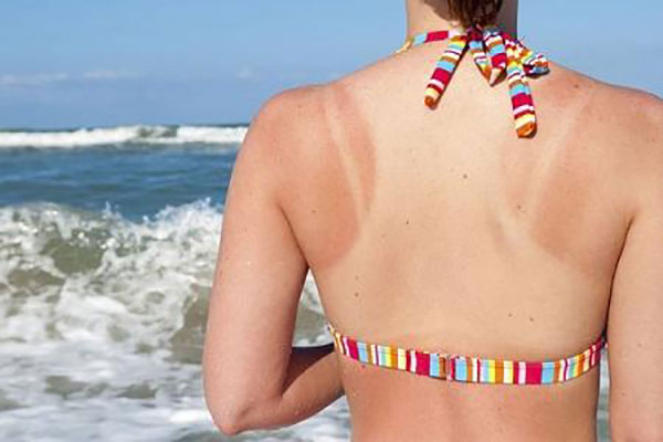 4 vấn đề về da thường gặp trong mùa hè