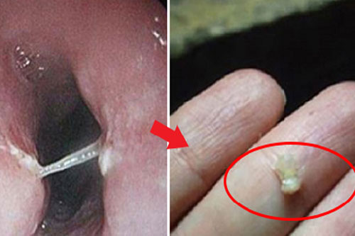 Mẹo chữa hóc xương cá chỉ trong '1 nốt nhạc' mà không cần đi gặp bác sĩ