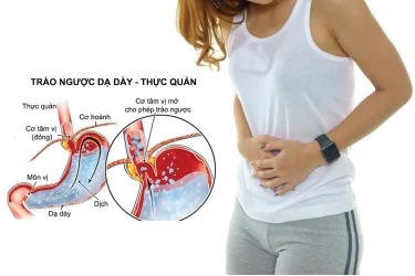 Trào ngược dạ dày khiến người bệnh khó chịu, mệt mỏi.