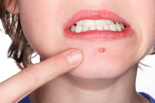 3 cách giúp bạn trị mụn bọc tại nhà hiệu quả