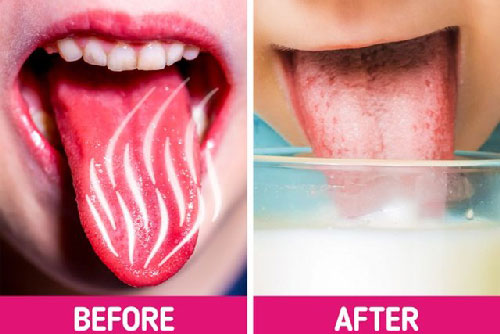 Lưỡi bị bỏng rát khi ăn đồ quá nóng cứ làm theo cách này là khỏi ngay tức khắc