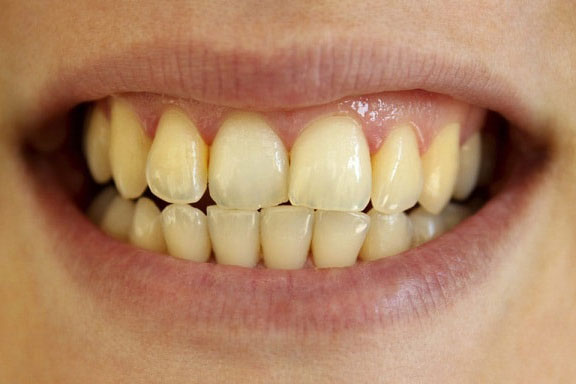 2 cách giúp hàm răng trắng tự nhiên