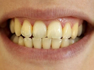 2 cách giúp hàm răng trắng tự nhiên