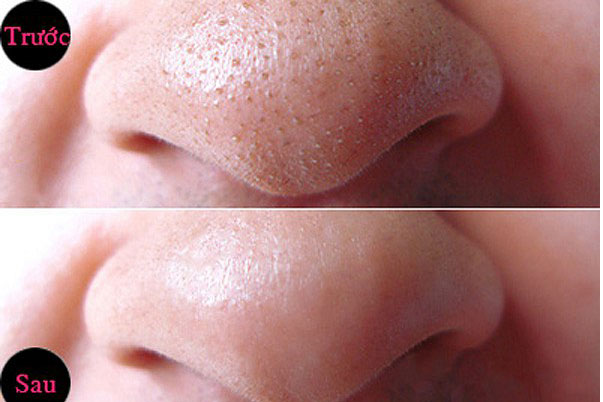 Công thức trị mụn đầu đen chỉ với mật ong và chanh