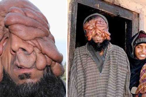 Người đàn ông “không có mặt” dị dạng từ khi mới sinh ra nhưng vẫn gây ngỡ ngàng với nghị lực sống và mối tình đẹp như mơ