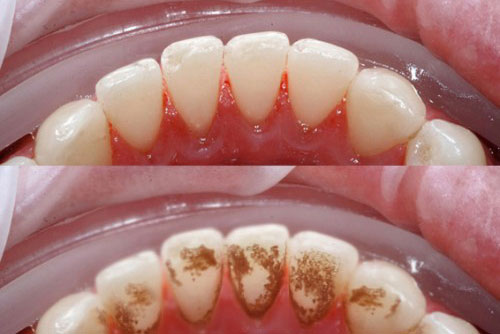 Dùng 1 chiếc bánh mỳ cao răng bao nhiêu cũng bong sạch