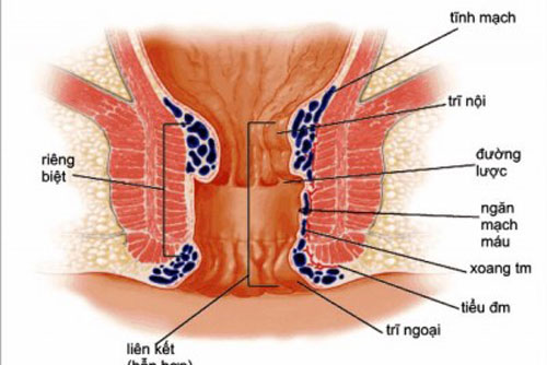 Phòng trị bệnh trĩ bằng nguyên liệu thiên nhiên hiệu quả ít ai ngờ
