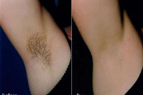 5 cách triệt lông tại nhà bằng nguyên liệu tự nhiên, vừa an toàn vừa hiệu quả