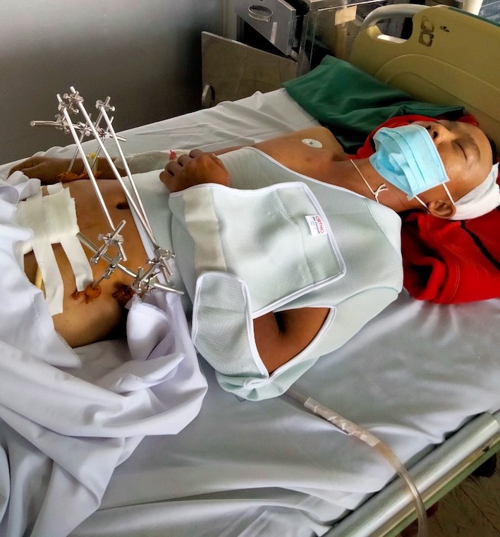 Công an viên bị trọng thương khi truy đuổi nghi phạm cần hỗ trợ chi phí phẫu thuật