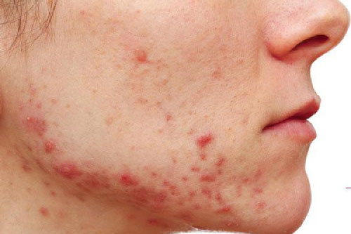 Bạn đã biết cách trị mụn do nội tiết gây ra?