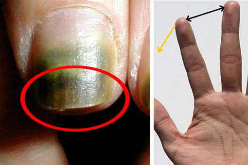 3 vấn đề ở ngón tay giữa cho thấy gan đang rất xấu, ai không có nên ăn mừng ngay