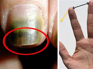 3 vấn đề ở ngón tay giữa cho thấy gan đang rất xấu, ai không có nên ăn mừng ngay