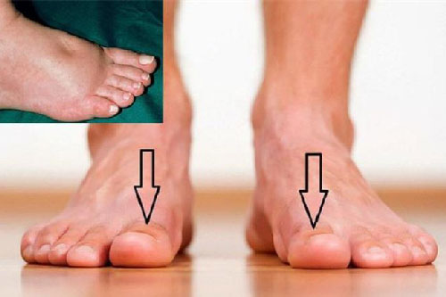 Muốn biết thận khỏe mạnh hay không, cứ nhìn vào 5 điểm ở bàn chân là rõ