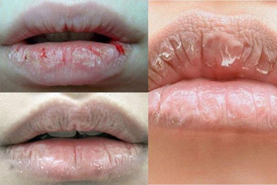 Chữa môi khô không khó như bạn nghĩ đâu nhé