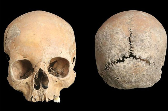 Ám ảnh hộp sọ thiếu nữ cổ đại bị cắt mũi, môi, gọt da đầu