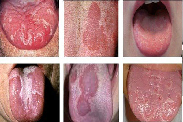 Ung thư lưỡi dễ nhầm là bệnh răng miệng thông thường