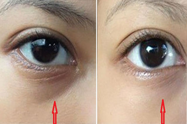 Giúp bạn hết thâm mắt ngay ngày hôm nay một cách đơn giản