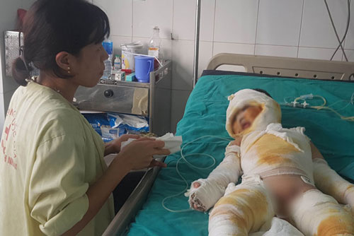 Những sai lầm khi sơ cứu, điều trị bỏng, mọi người cần tránh tuyệt đối