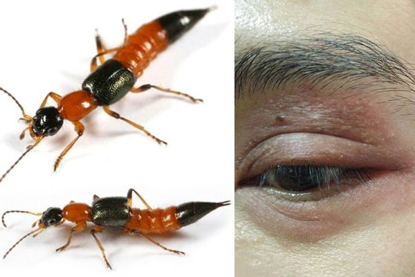 L&#xE0;m g&#xEC; khi b&#x1ECB; ki&#x1EBF;n ba khoang c&#x1EAF;n?