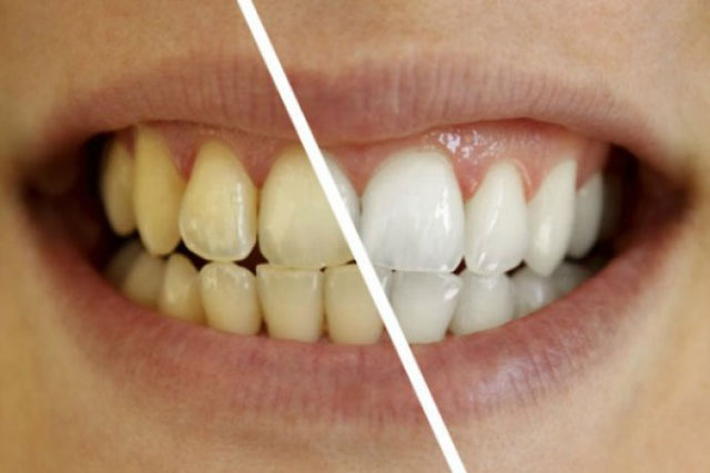Cách đơn giản để giải quyết răng ố vàng bạn phải biết