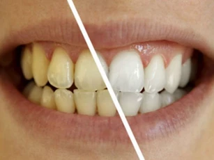 Cách đơn giản để giải quyết răng ố vàng bạn phải biết