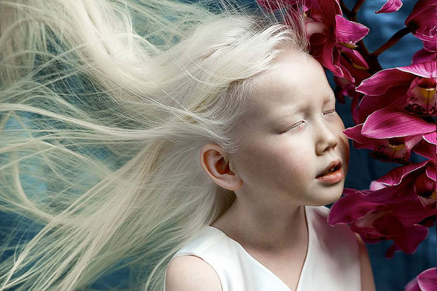 9 em bé nổi tiếng khắp thế giới vì quá đỗi đặc biệt: Từ “người sói”, cô bé tóc hai màu đến “công chúa tuyết” đẹp như bước ra từ cổ tích