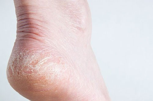 Da chân hết khô, nứt nẻ trong 1 đêm