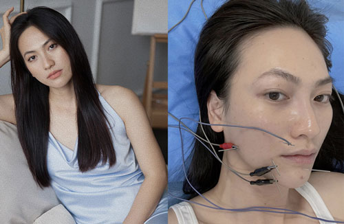Nữ diễn viên Vbiz chia sẻ bị bệnh tuyến giáp, hoảng vì tê cứng và méo khung môi