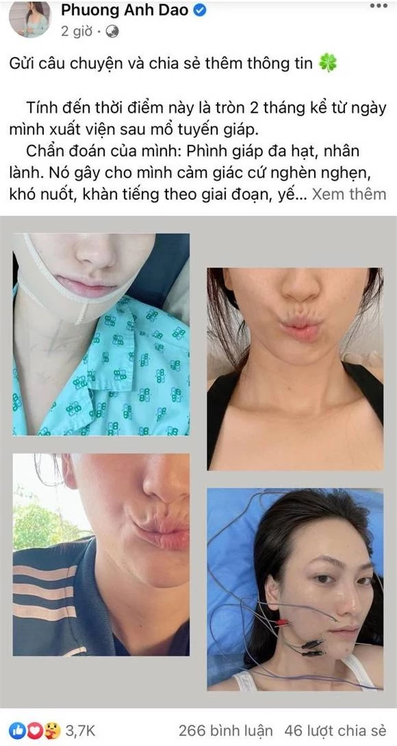 Phương Anh Đào bất ngờ chia sẻ về việc điều trị bệnh tuyến giáp: Tôi rất hoảng vì tê cứng và méo khung môi - Ảnh 2.