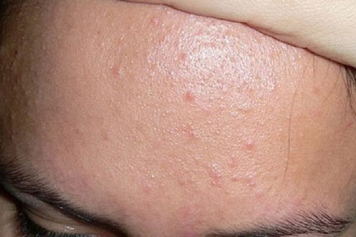 Mụn ẩn dưới da: Chữa trị không khó
