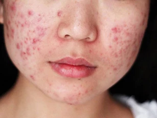 Chăm sóc da bị mụn trứng cá như thế nào?