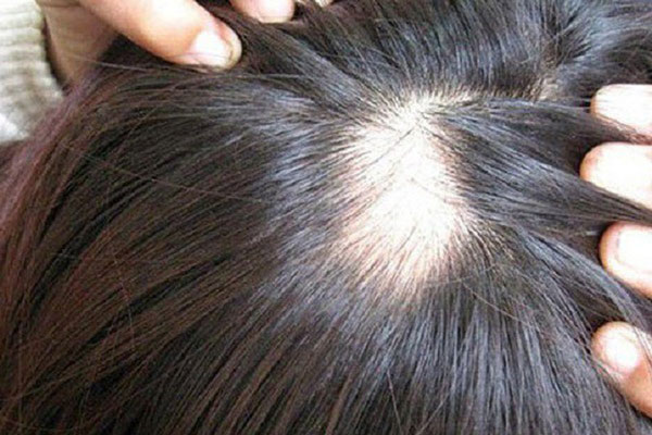 2 cách trị rụng tóc mà không tốn tiền