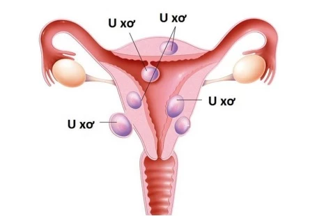 U xơ tử cung là bệnh phụ khoa phổ biến ở nữ giới trong độ tuổi sinh sản.
