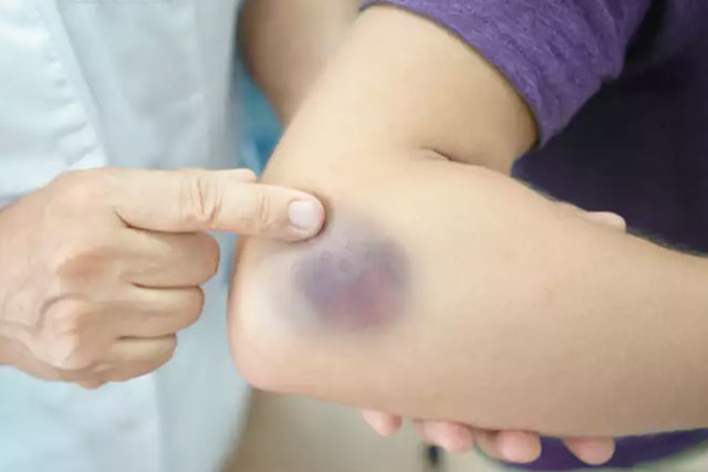 Vết bầm tím trên cơ thể, tưởng đơn giản nhưng có thể là dấu hiệu cảnh báo bệnh lý nguy hiểm