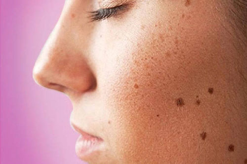 Phòng tránh đồi mồi trên da khi thời tiết nắng nóng