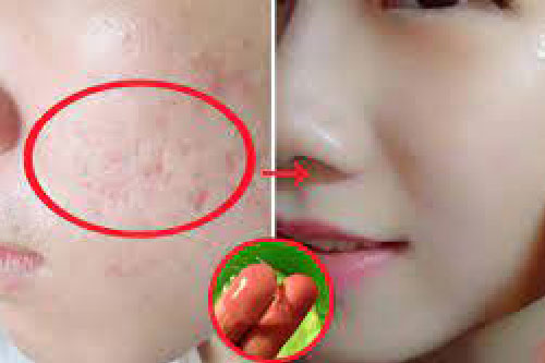 Mặt nạ trị sẹo rỗ hiệu quả từ thiên nhiên