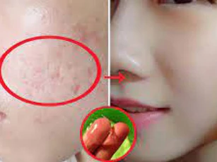 Mặt nạ trị sẹo rỗ hiệu quả từ thiên nhiên