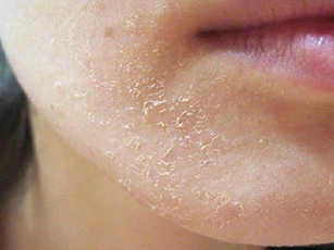 5 dấu hiệu tố cáo làn da đang bị hư tổn