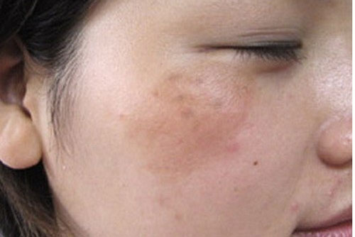 Bạn có biết tại sao mùa đông da vẫn bị nám?