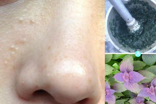 Không cần dùng tia laser mụn thịt cũng 'bay' hết với lá này