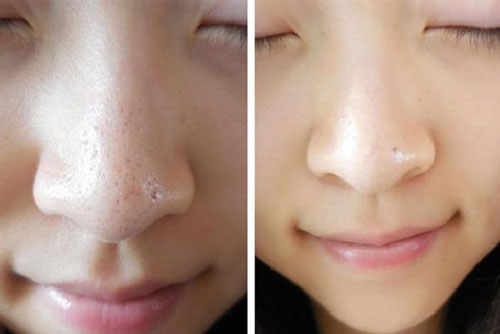 3 công thức trị mụn đầu đen tại nhà đơn giản nhất