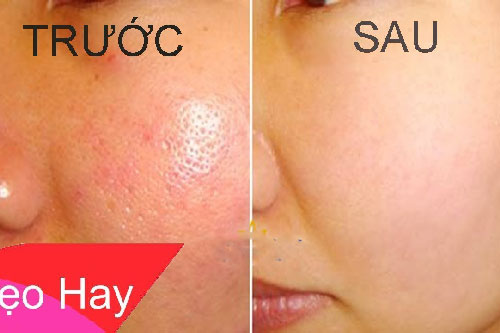 Lỗ chân lông to mấy cũng thu nhỏ chỉ bằng cách đơn giản