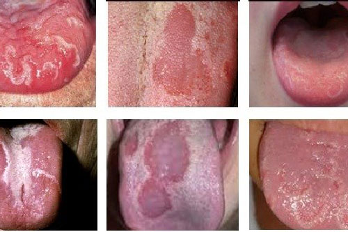 Biểu hiện cảnh báo ung thư lưỡi nhưng ai cũng không quan tâm