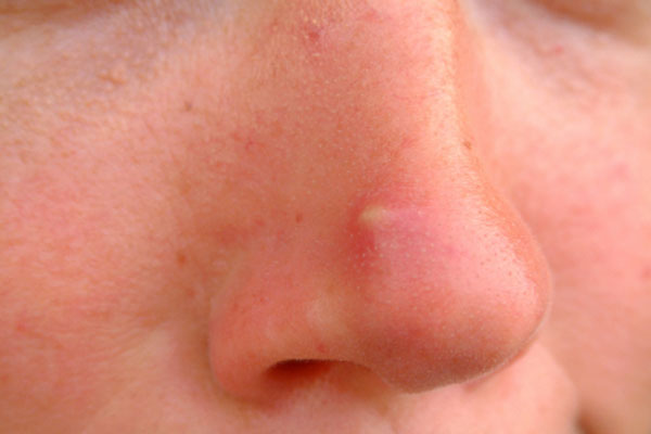 Vị trí mụn mọc trên mặt cảnh báo nhiều bệnh