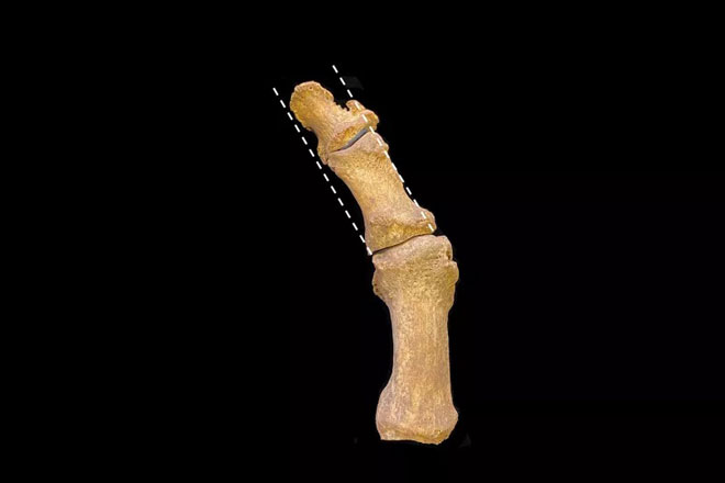 Bí ẩn những đôi chân dị tật ở giới quý tộc Anh thời trung cổ