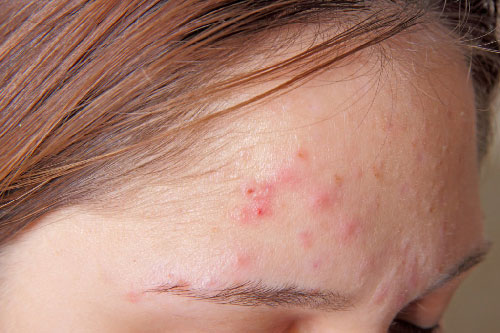 Công thức trị mụn trứng cá tại nhà đơn giản nhất