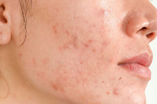 Giải quyết triệt để tình trạng thâm mụn tại nhà