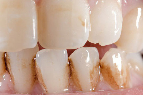 Lý do răng xỉn màu không nhiều người biết